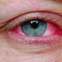 Открыт новый вид лечения глаукомы