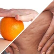 Как избавиться от целлюлита без затрат: самые эффективные средства 