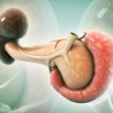 Болезнь Гоше