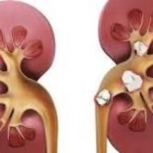 Медики назвали первые признаки появления камней в почках