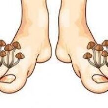 Грибок кожи и ногтей: лучшие средства народной медицины