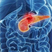 Рак поджелудочной железы. 4 признака болезни, которые скрываются в стуле