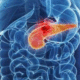 Рак поджелудочной железы. 4 признака болезни, которые скрываются в стуле