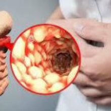 Болезнь Крона