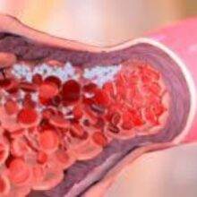 Коронавирус: пациенты с тяжелой формой страдают венозной тромбоэмболией