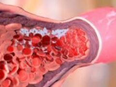 Коронавирус: пациенты с тяжелой формой страдают венозной тромбоэмболией