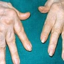 Деформирующий артроз