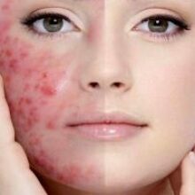 Ученые: лечить акне можно пробиотиками