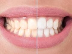 Почему желтеют зубы: неочевидные ошибки в питании и уходе