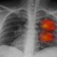 Рак легких: пять неожиданных признаков опасного заболевания