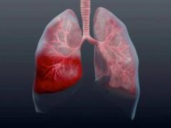 Пневмония без кашля и температуры: как распознать опасное заболевание у ребенка