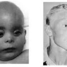 Фенилкетонурия: что это за болезнь и как она проявляется