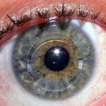 Кератоконус