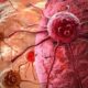 Рак яичников, простаты и молочной железы: как они передаются по наследству