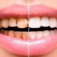 Художественная реставрация: эффективный способ спасти поврежденные зубы
