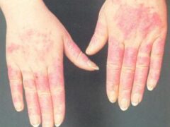 Аллергия на холод: что это такое и как ее распознать