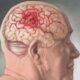 Симптомы рака мозга: нарушение зрения и другие сигналы опухоли