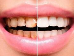 Художественная реставрация: эффективный способ спасти поврежденные зубы