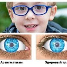 У кого развивается астигматизм и помогут ли очки, контактные линзы