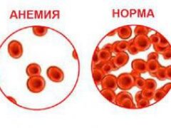 Хроническая анемия