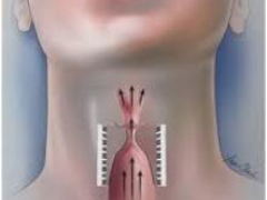 Медики предупредили о симптомах онкологических заболеваний горла