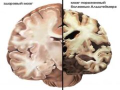 Как протекает болезнь Альцгеймера: от первой до седьмой стадии