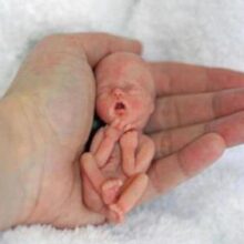 Прервать жизнь: какие виды абортов существуют