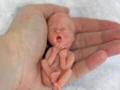 Прервать жизнь: какие виды абортов существуют